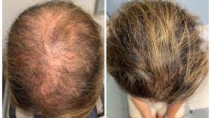 Healthy Hair Growth for Men