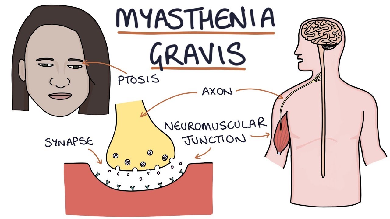 Myasthenia Gravis people